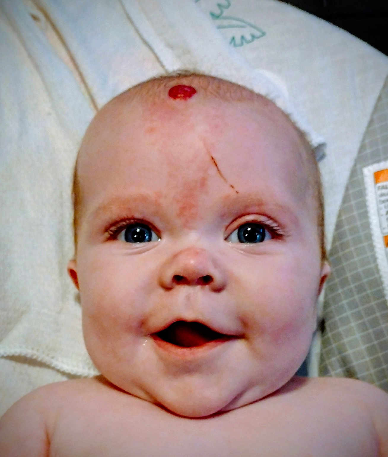 Charley joined the competition — help win amazing prizes! baby, infant, face, blue_eyes, smile, skin, head, towel, mark, scratch, closeup, child, person, happy, expression, cute, young, portrait, indoors, skin_detail