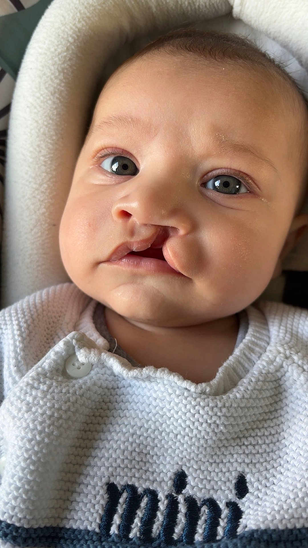 Hayden participe au concours pour gagner de l'argent avec cette photo : baby, infant, close_up, face, cleft_lip, eyes, knitted_sweater, white_clothing, cute, child, portrait, soft_light, indoors, cushion, button, newborn, skin, expression, young_child, seated