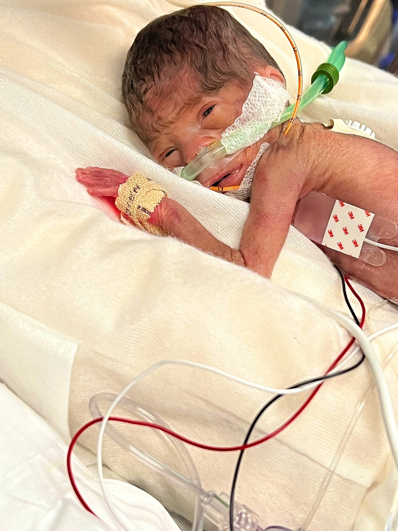 Miracle is registered to the contest to win money with this photo: audio_equipment, baby, baby_products, baby_sleeping, cable, carmine, child, comfort, elbow, electrical_wiring, event, eyelash, finger, hospital, human_body, linens, patient, person, room, skin