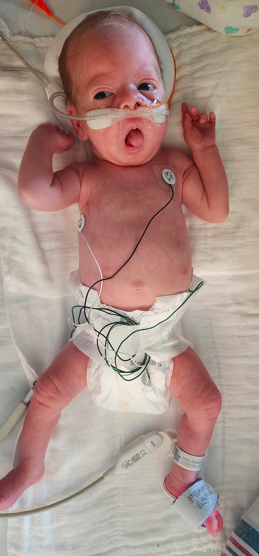 Emmalina is registered to the contest to win money with this photo: baby, infant, medical_equipment, hospital, monitoring_wires, nasal_cannula, diaper, bed, skin, newborn, healthcare, patient, hospital_bed, medical_care, person, lying_down, wrinkled_skin, head, hand, foot