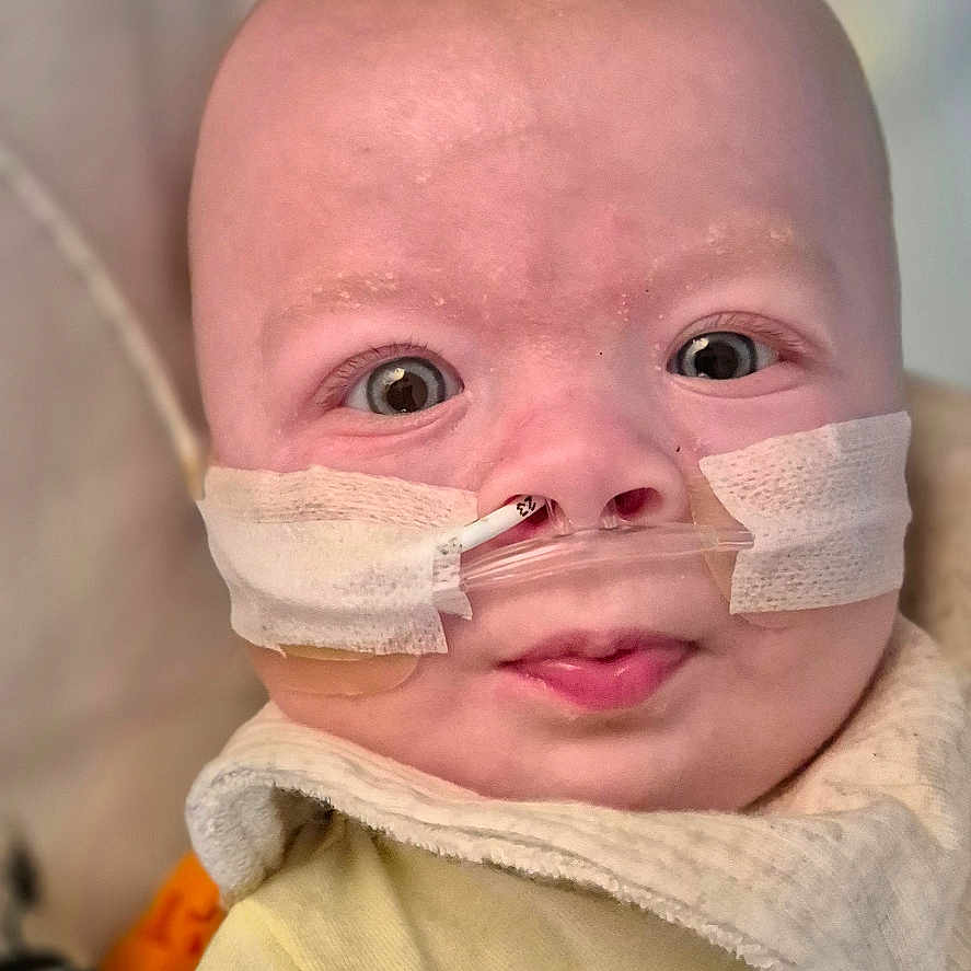 Alaric joined the competition — help win amazing prizes! baby, bib, child, close_up, cute, expression, face, head, healthcare, hospital, infant, medical_tape, nasal_cannula, patient, portrait, skin, treatment, wide_eyes, yellow_clothing, young_child