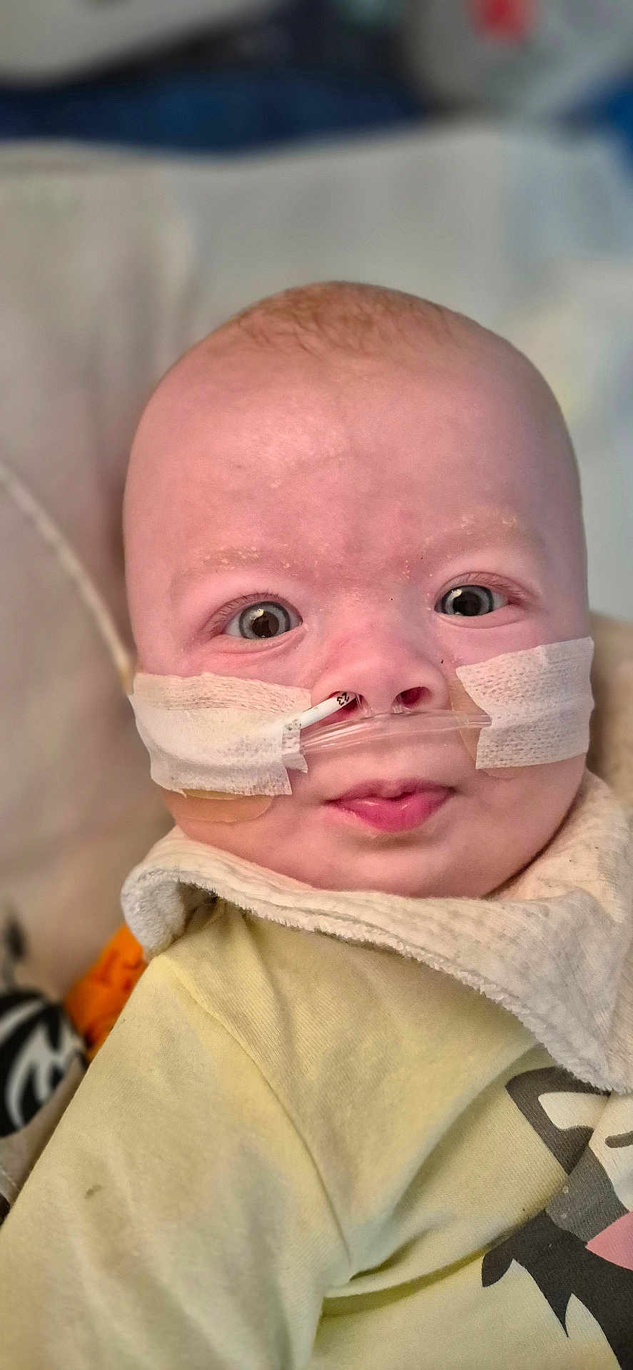 Alaric joined the competition — help win amazing prizes! baby, infant, face, nasal_cannula, medical_tape, wide_eyes, yellow_clothing, bib, close_up, hospital, patient, expression, skin, head, child, portrait, healthcare, treatment, young_child, cute