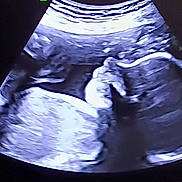 Autumn joined the competition — help win amazing prizes! fetus, unborn_baby, ultrasound, prenatal, pregnancy, medical_imaging, womb, embryo, developing_baby, baby_profile, hand, face, curled_position, sonogram, healthcare, obstetrics, maternal_health, medical_screen, black_and_white, expectant_parent