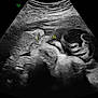 ultrasound, fetus, prenatal, baby, womb, medical_scan, grayscale, sonogram, healthcare, pregnancy, development, anatomy, monitoring, gestation, black_and_white, medical_imaging, clinic, scan, labeled, diagnostic