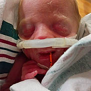 Josephine joined the competition — help win amazing prizes! newborn, baby, infant, sleeping, hospital, medical_equipment, feeding_tube, blanket, swaddled, face, closed_eyes, tiny_hands, striped_fabric, indoors, portrait, close_up, nursery, care, resting, photography