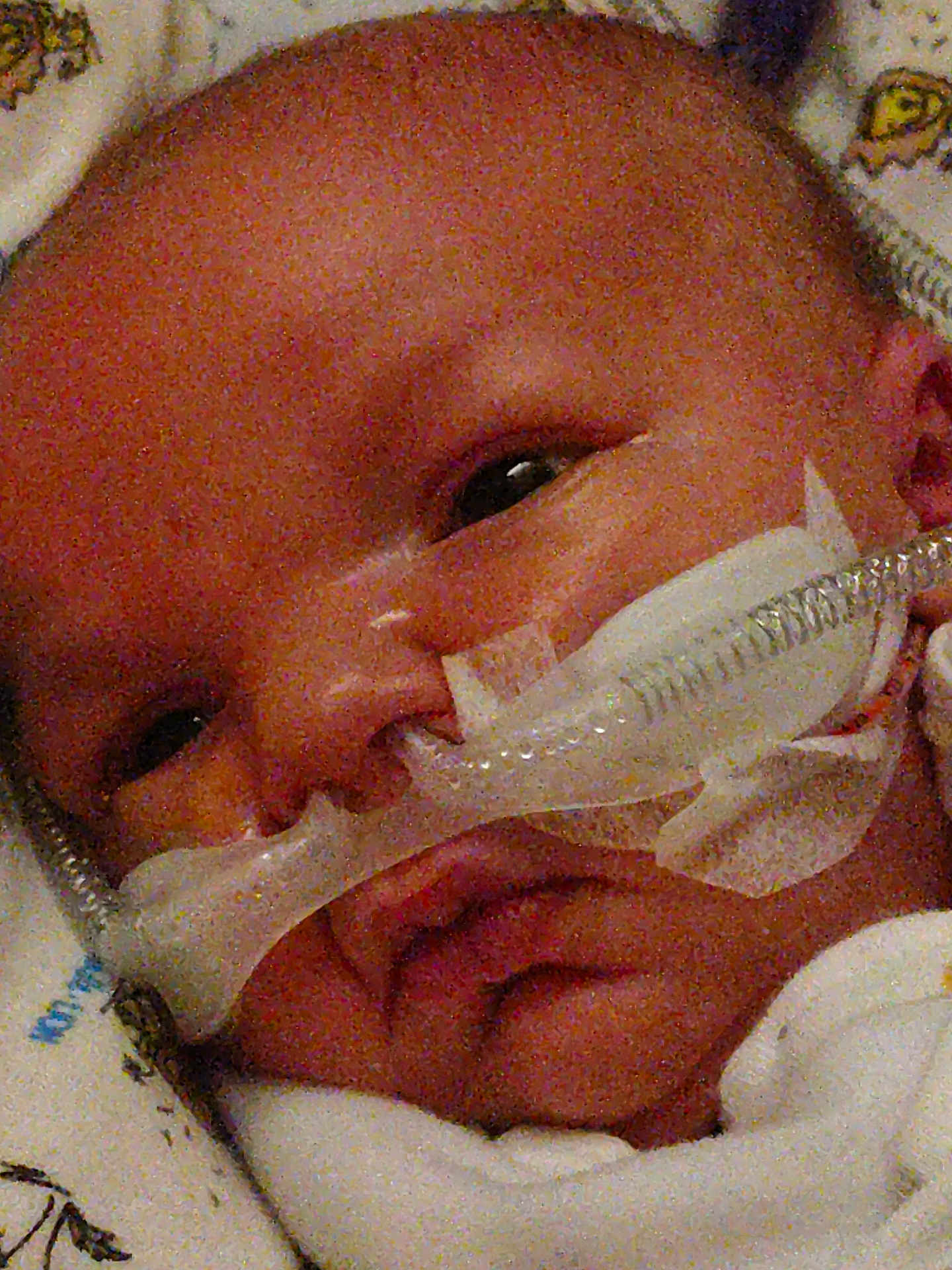 Walker is registered to the contest to win money with this photo: baby, newborn, face, nasal_cannula, medical_equipment, blanket, closeup, infant, hospital, healthcare, person, skin, head, sleeping, child, cute, fragile, resting, tubes, wrapped