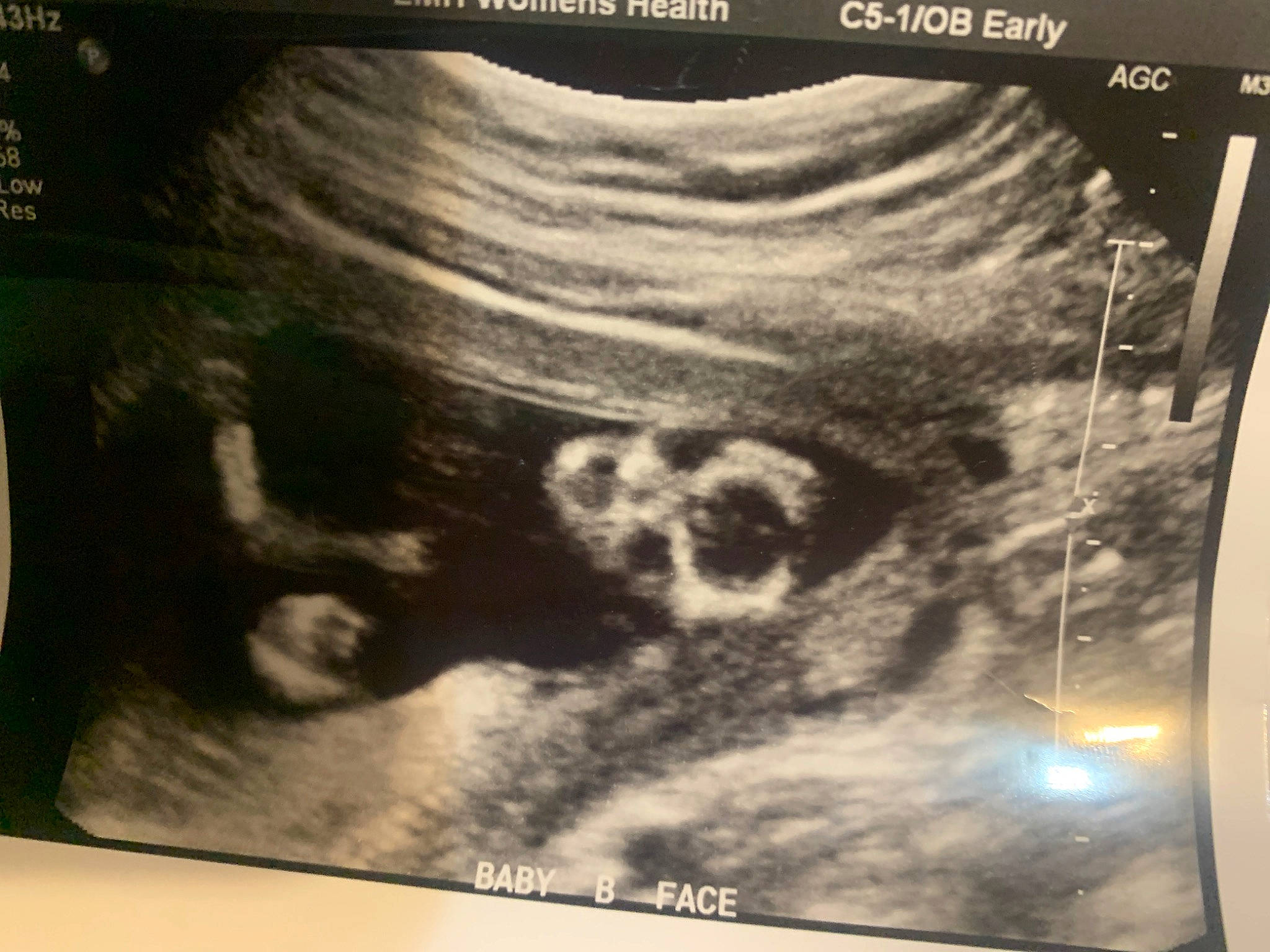 Twins is registered to the contest to win money with this photo: art, display_device, event, font, human_body, medical, medical_imaging, medical_radiography, multimedia, obstetric_ultrasonography, radiography, radiology, science, service