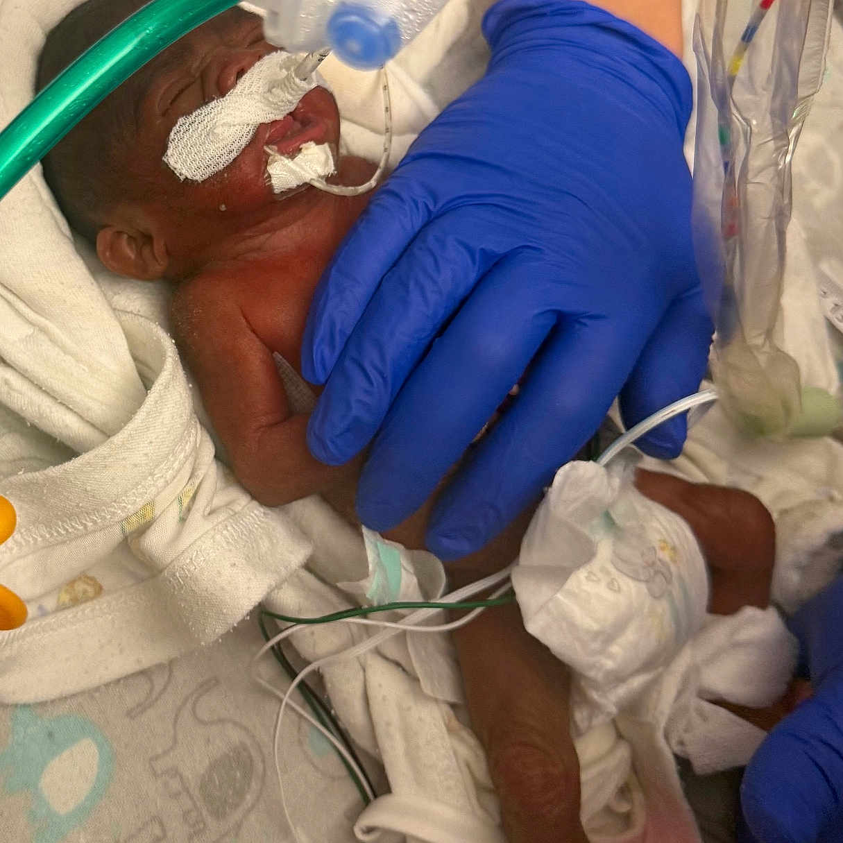 Brittan is registered to the contest to win money with this photo: baby, premature_baby, hospital, medical_equipment, gloves, incubator, life_support, tube, sensor, diaper, bed, blanket, care, healthcare, infant, neonatal, person, patient, hand, monitoring