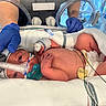 baby, blanket, breathing_tube, care, diaper, gloves, healthcare, hospital, incubator, infant, lying_down, medical_care, medical_equipment, monitoring_wires, neonatal, newborn, patient, person, premature_baby, tiny