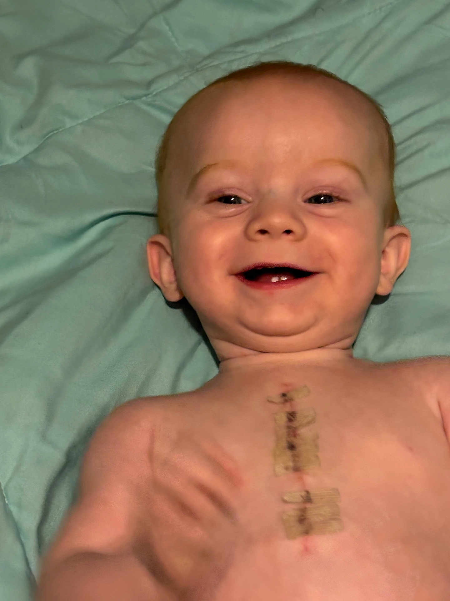 Dino is registered to the contest to win money with this photo: baby, smiling, face, child, skin, teeth, medical_dressing, bandage, chest, lying_down, blanket, hand, infant, happy, closeup, portrait, young_child, human, expression, healthcare