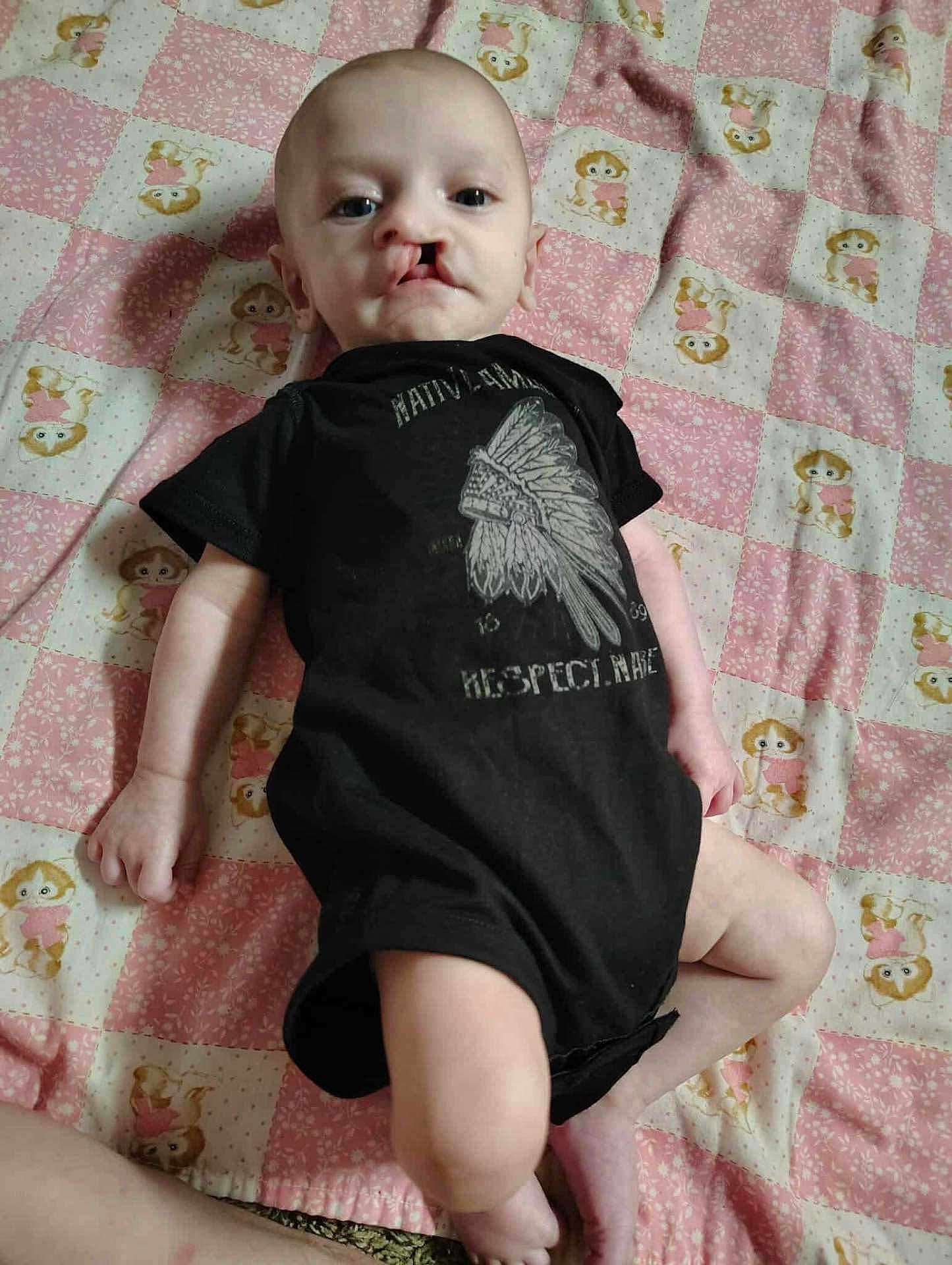 Colton Michael is registered to the contest to win money with this photo: baby, infant, child, onesie, black_clothing, blanket, patterned_blanket, cartoon_animals, cleft_lip, face, portrait, lying_down, indoors, cute, young_child, expression, human, skin, head, eyes