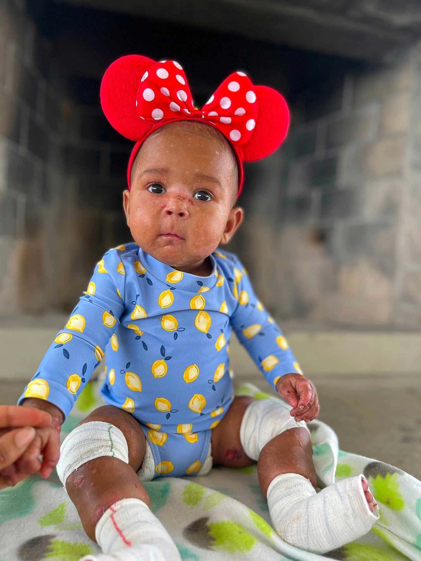 Love is registered to the contest to win money with this photo: baby, child, bandage, headband, red, blue_clothing, lemon_pattern, blanket, sitting, hand_holding, face, expression, indoor, stone_wall, cute, infant, person, foot_bandage, leg_bandage, portrait